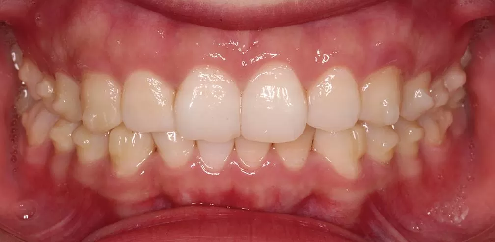 S8-SGTB Avance mandibular