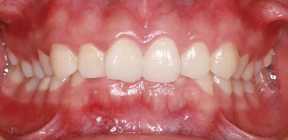 S8-SGTB Avance mandibular