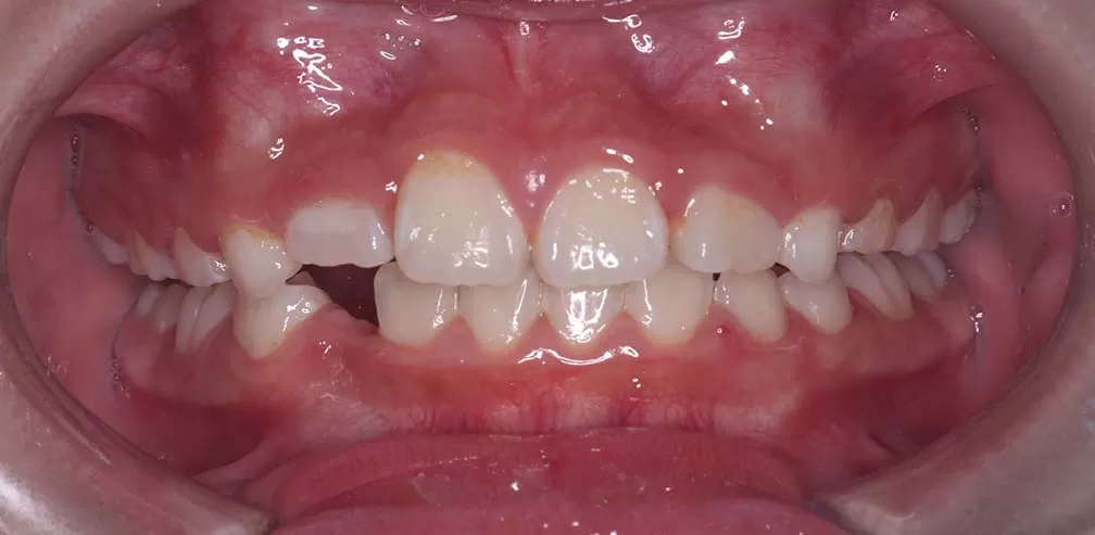 Smartee Kinder - Ectopia dental individual