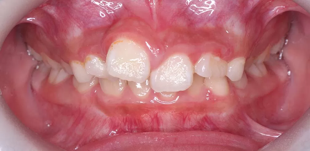 Smartee Kinder - Ectopia dental individual