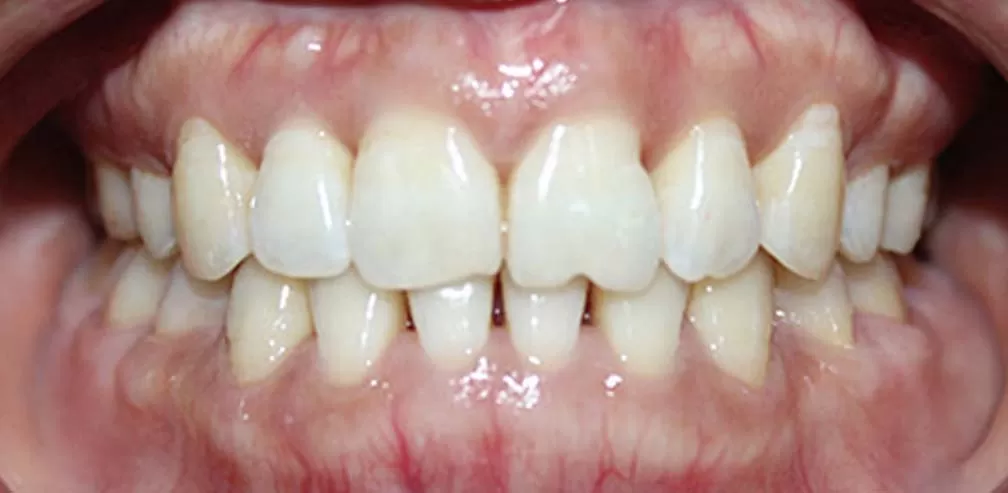 Extracción de premolares y mordida cruzada de dientes individuales