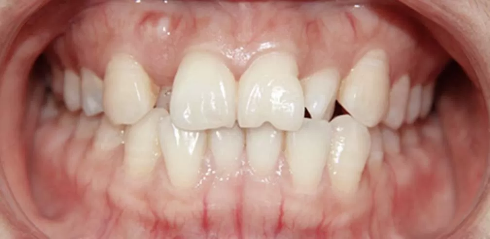Extracción de premolares y mordida cruzada de dientes individuales