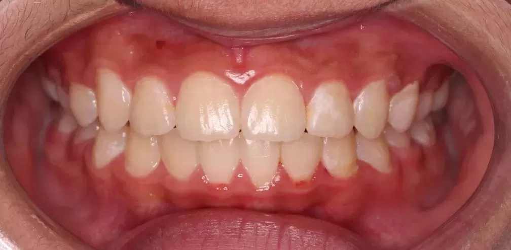 Smartee Teen - Convexidad Facial - Retrusión Mandibular, Varón de 12 Años