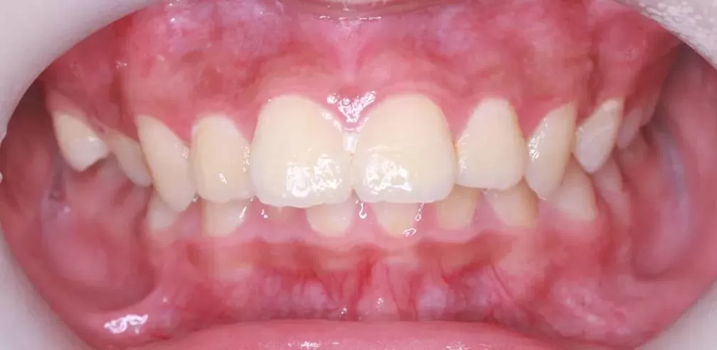 Smartee Teen - Convexidad Facial - Retrusión Mandibular, Varón de 12 Años
