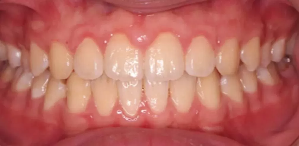 Smartee Teen - Convexidad facial - Retrusión mandibular, 16 años