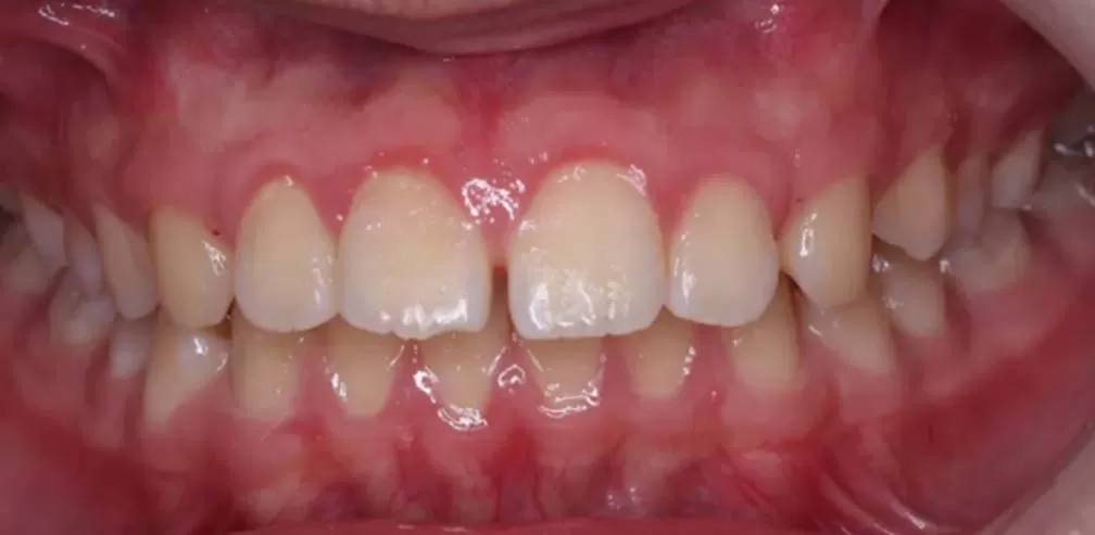 Smartee Teen - Convexidad facial - Retrusión mandibular, 16 años
