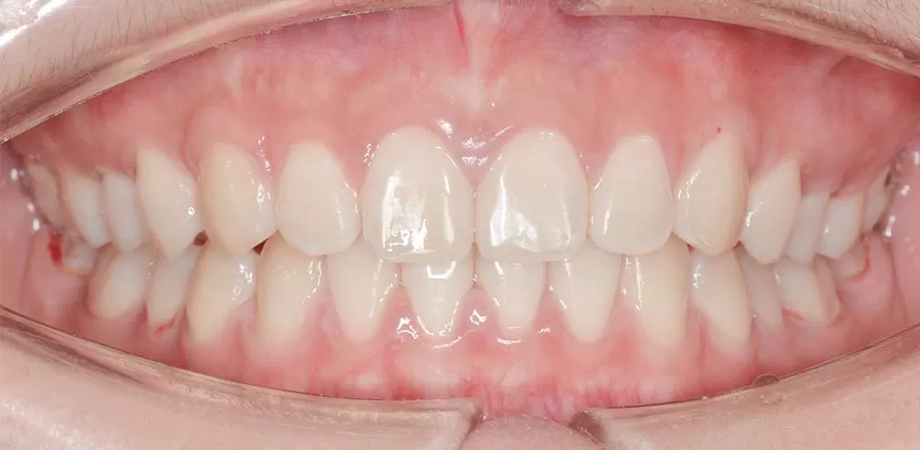 Resalte profundo, distalización maxilar y avance mandibular