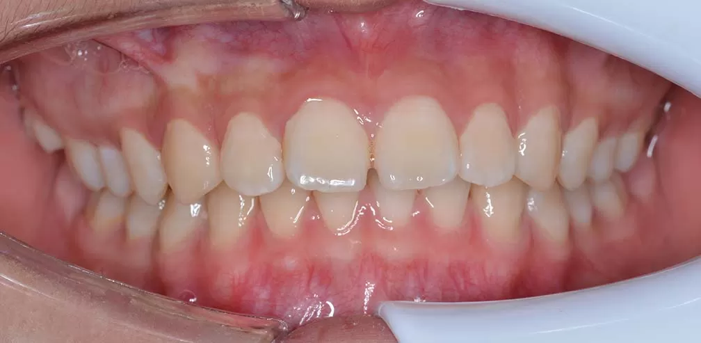 Resalte profundo, distalización maxilar y avance mandibular