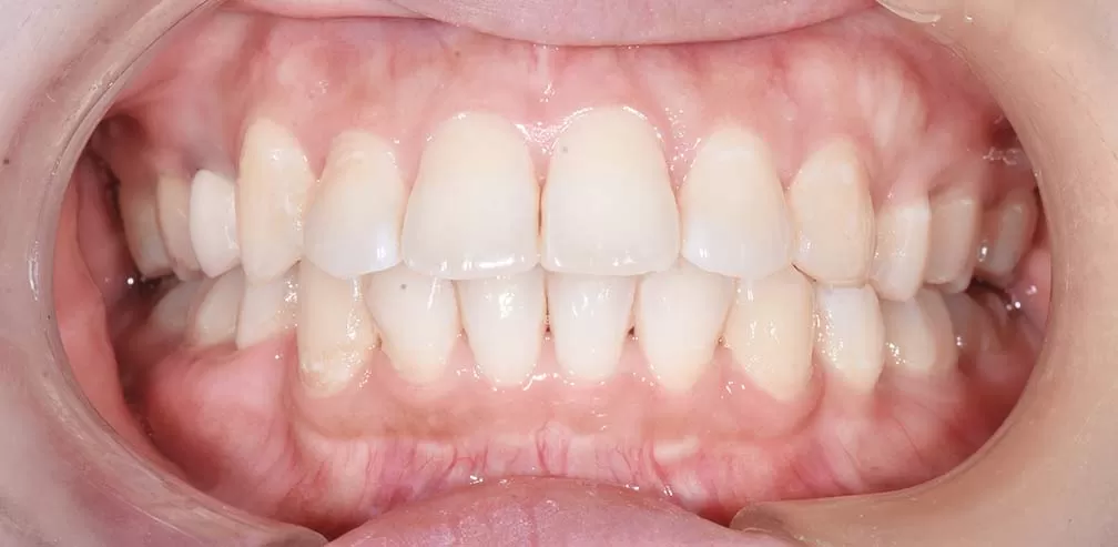 Tratamiento asistido con TAD para protrusión bimaxilar