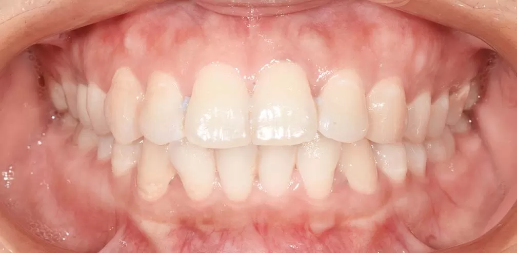 Tratamiento asistido con TAD para protrusión bimaxilar
