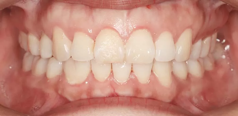 Protrusión de los dientes anteriores