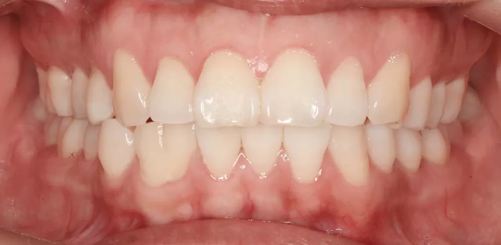 Protrusión de los dientes anteriores