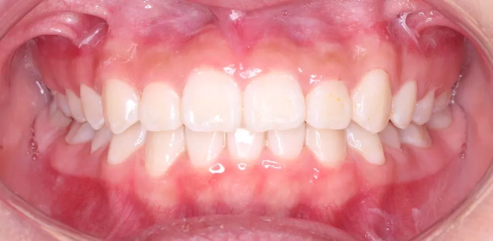 Smartee Teen - Convexidad facial - Retrusión mandibular, mujer de 12 años