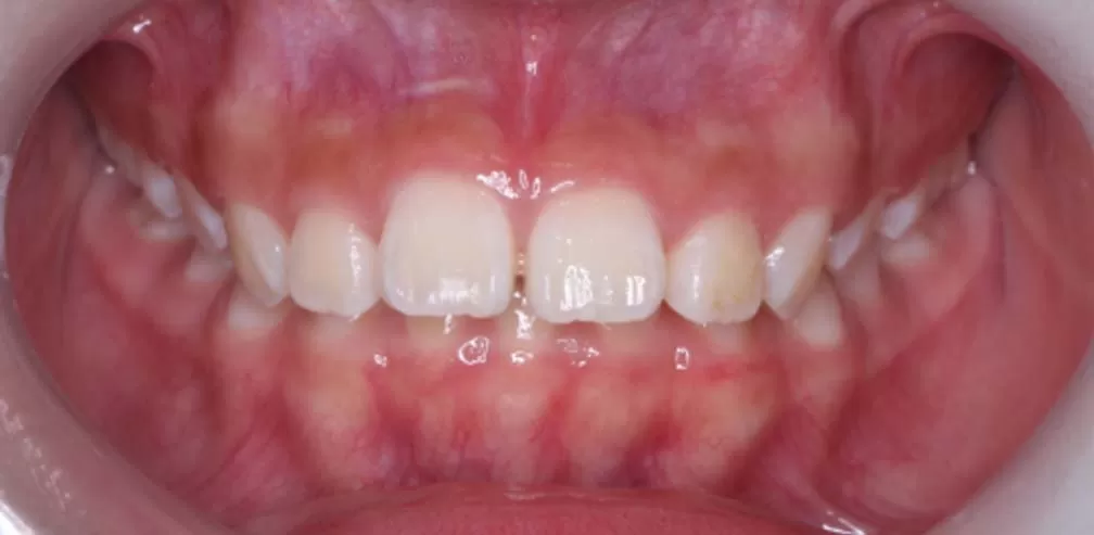 Smartee Teen - Convexidad facial - Retrusión mandibular, mujer de 12 años
